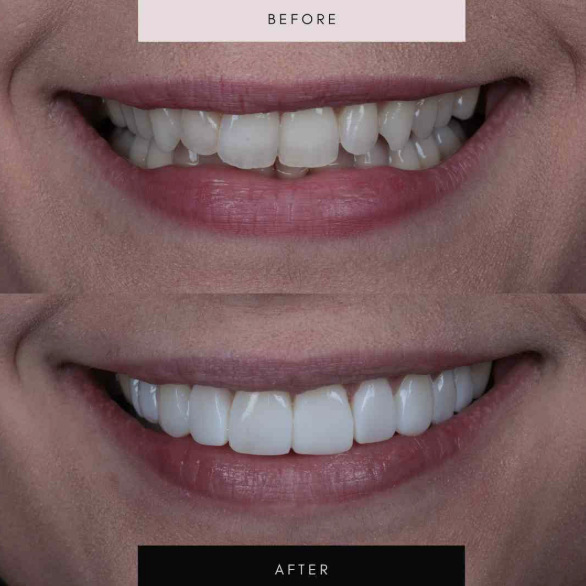 Composite bonding, before and after