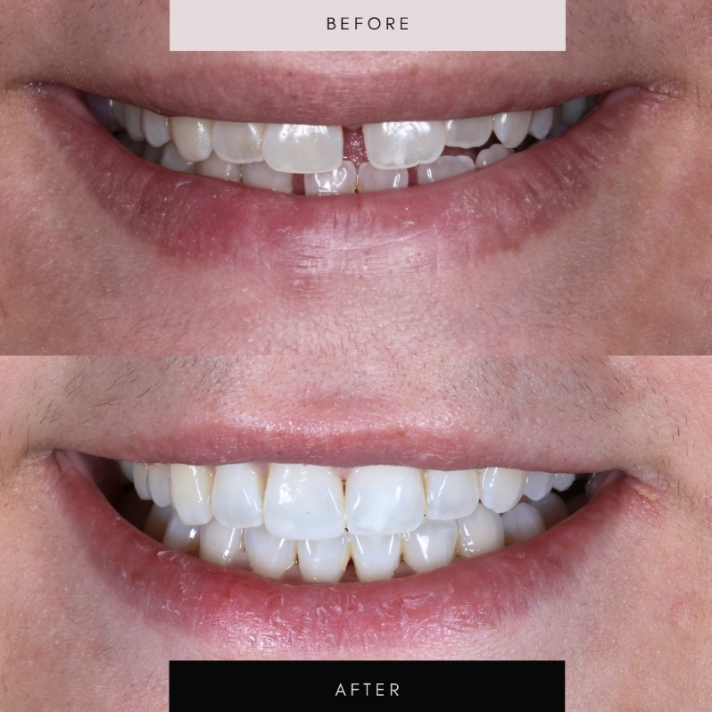 Invisalign, before and after
