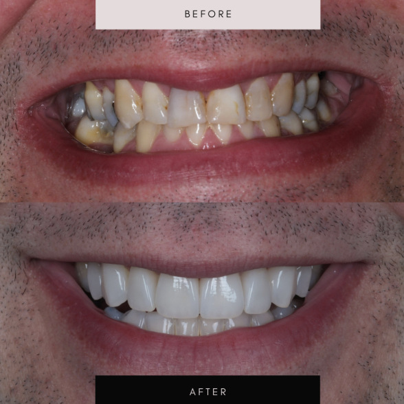 Porcelain veneers, before and after