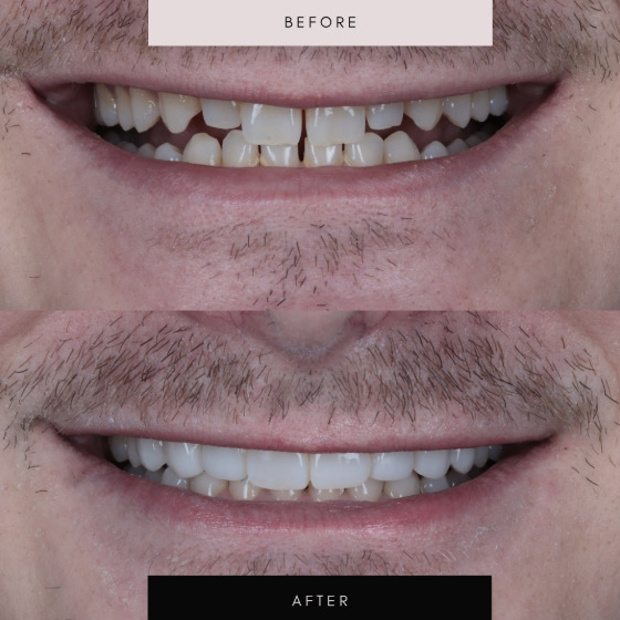 Composite bonding, case 01 — before and after