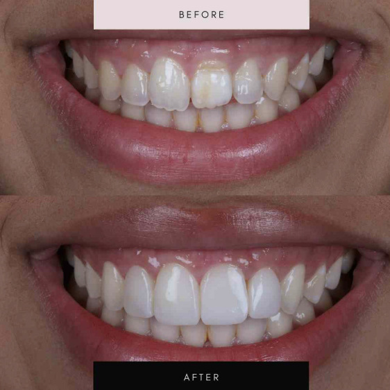Composite bonding, case 02 — before and after