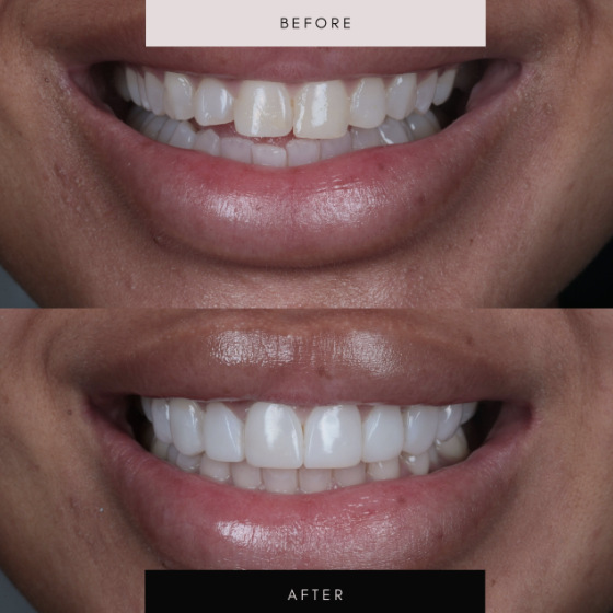 Composite bonding, case 03 — before and after