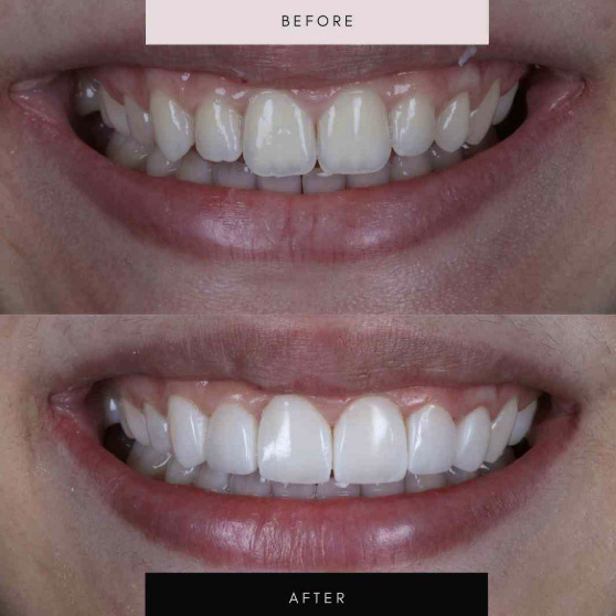 Composite bonding, case 04 — before and after