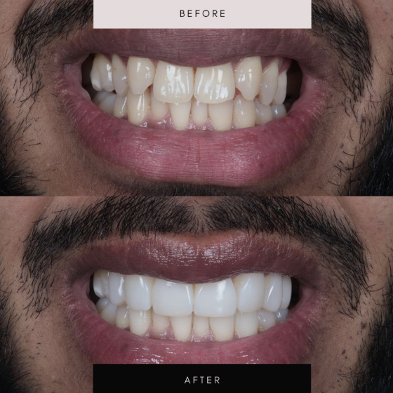 Composite bonding, case 05 — before and after