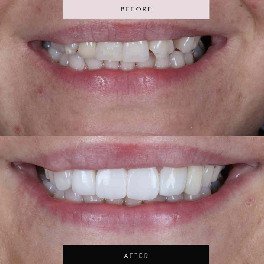 Composite bonding, case 06 — before and after