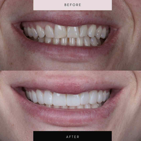 Composite bonding, case 07 — before and after