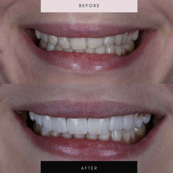 Composite bonding, case 08 — before and after