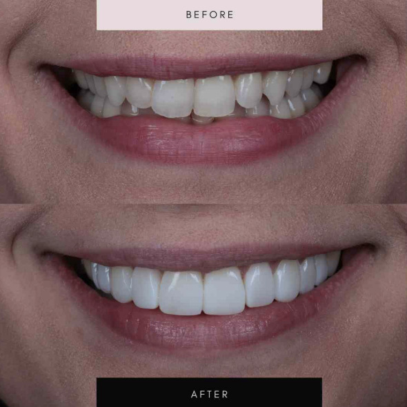 Composite bonding, case 09 — before and after
