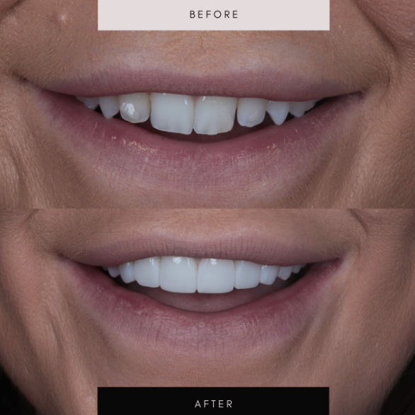 Composite bonding, case 10 — before and after