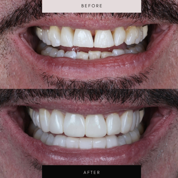 Composite bonding, case 11 — before and after