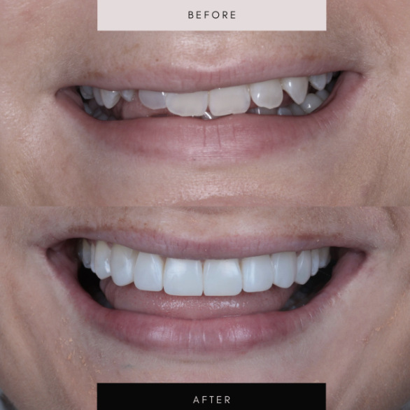 Composite bonding, case 12 — before and after