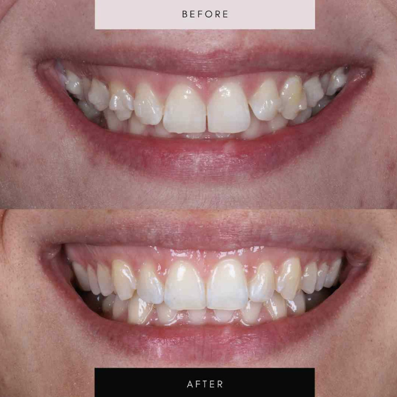 Invisalign, case 01 — before and after