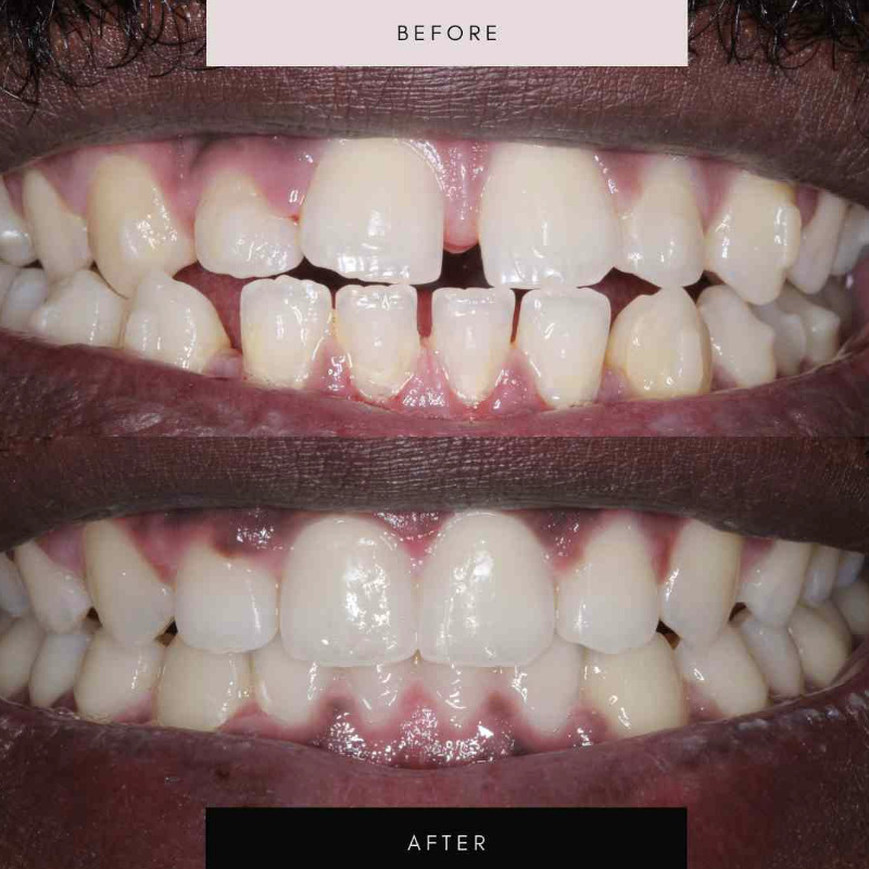 Invisalign, case 02 — before and after