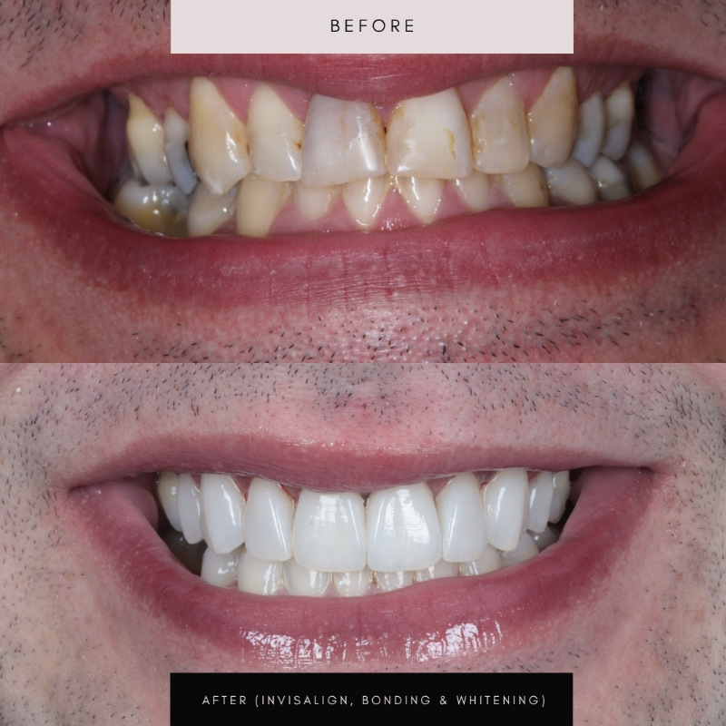 Invisalign, case 03 — before and after