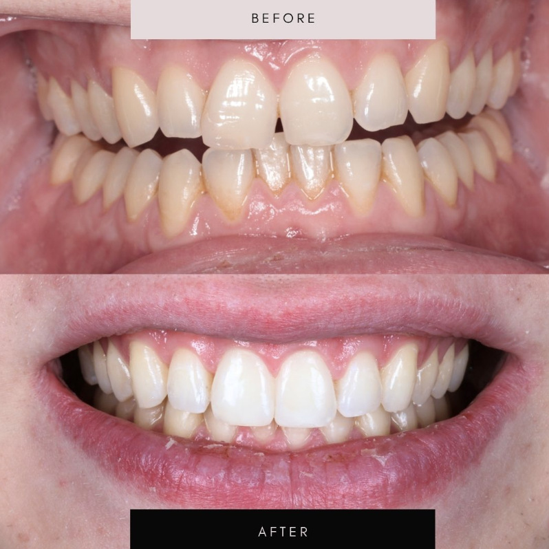 Invisalign, case 05 — before and after