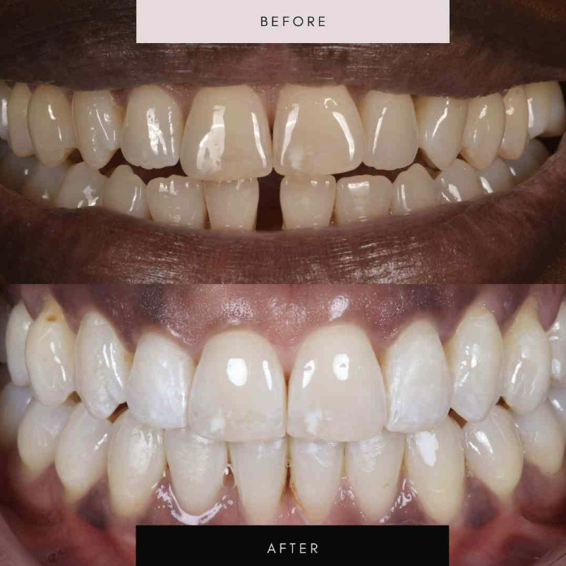 Invisalign, case 06 — before and after