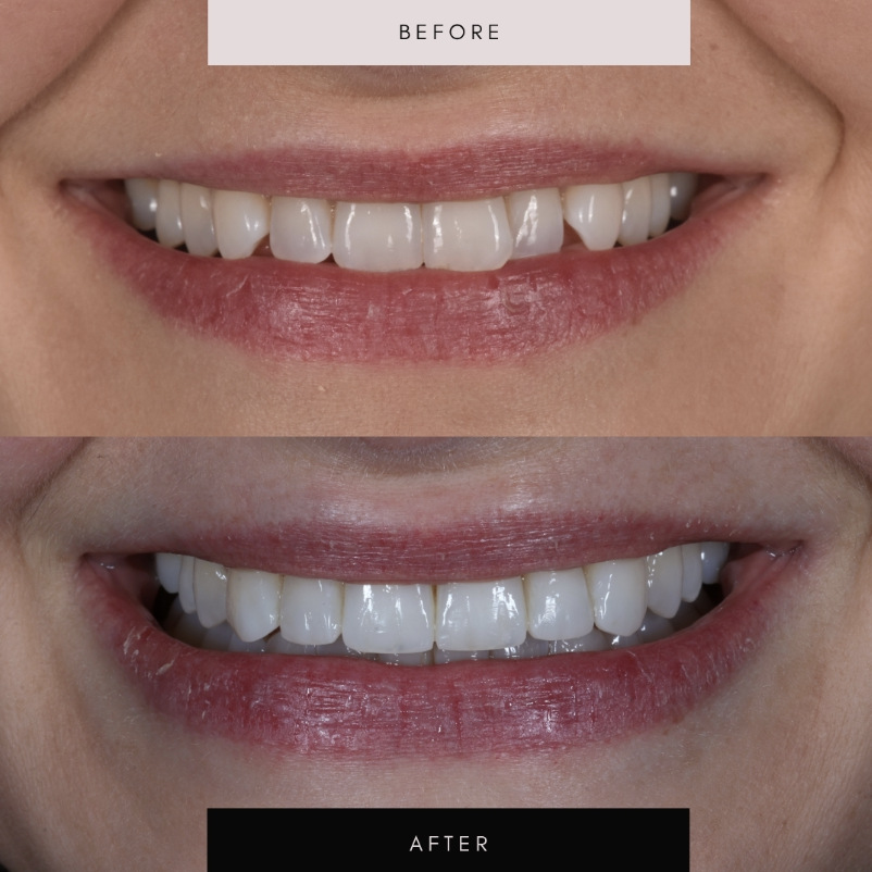 Invisalign, case 07 — before and after