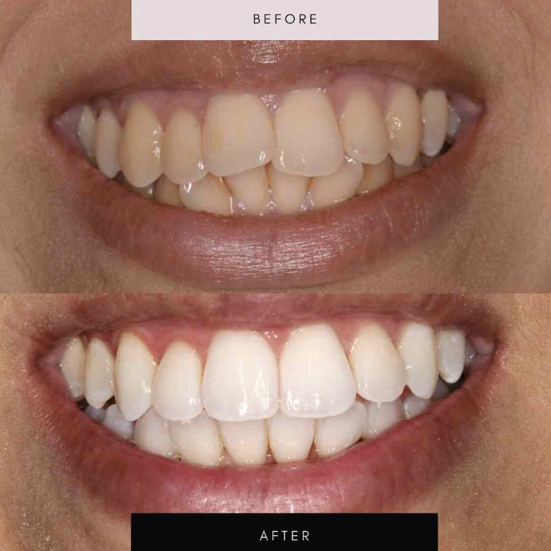 Invisalign, case 08 — before and after