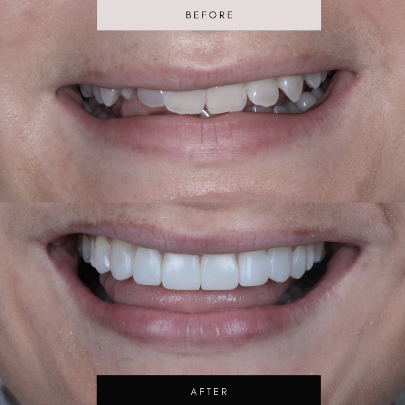 Invisalign, case 09 — before and after