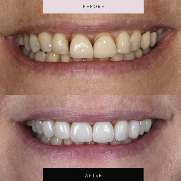Porcelain veneers, case 01 — before and after