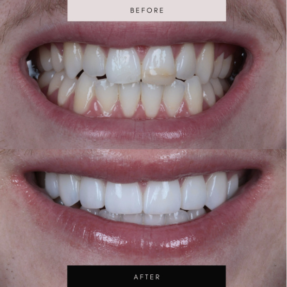 Porcelain veneers, case 02 — before and after
