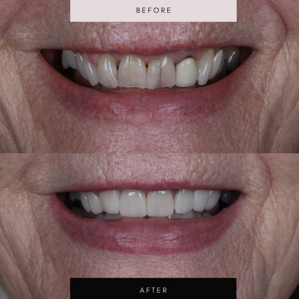 Porcelain veneers, case 03 — before and after