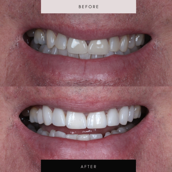 Porcelain veneers, case 04 — before and after