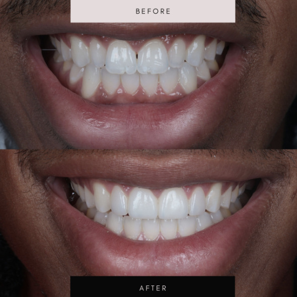 Porcelain veneers, case 05 — before and after