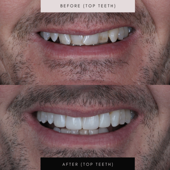 Porcelain veneers, case 07 — before and after