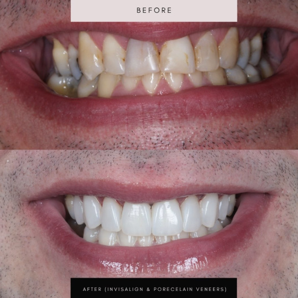 Porcelain veneers, case 08 — before and after